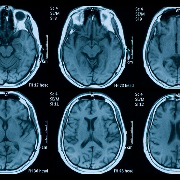 COVID Appears to Worsen Brain Function in Dementia Patients